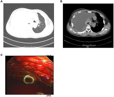 Case report: The first account of undifferentiated sarcoma with epithelioid features originating in the pleura